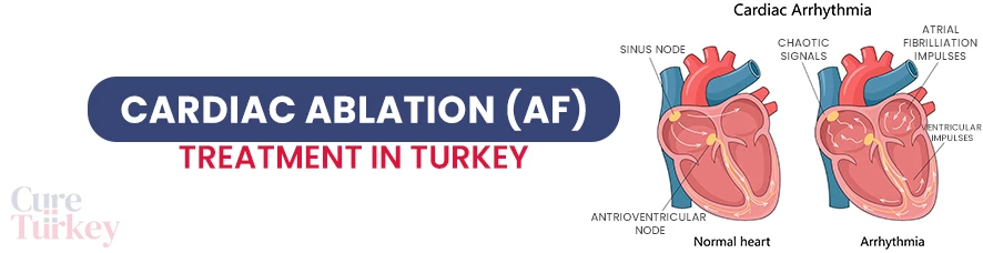 Cardiac Ablation Treatment